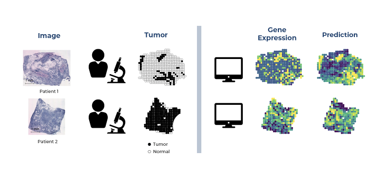 Diagram showing a 6-column computational process of predicting of diagnosis from tissue samples: Column 1: Image (black-and-white image of tumor cells on slides) Column 2: icon representing the pathologist who will annotate the tumor. Column 3: The Tumor map showing black dots annotating diseased cells. Column 4: Separated by gray bar and computer icons to show the start of the computational process. Column 5: Gene Expression maps showing different colors to map gene expressions for each cell. Column 6: An updated map of new diseased cells calculated by an algorithm predicting the progression of the disease.
