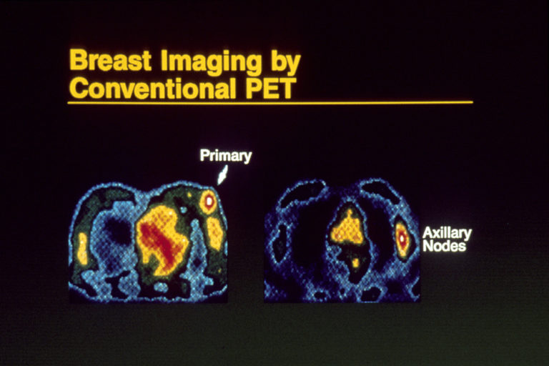 Graphic of Breast Imaging by Conventional PET displaying primary and axillary nodes.