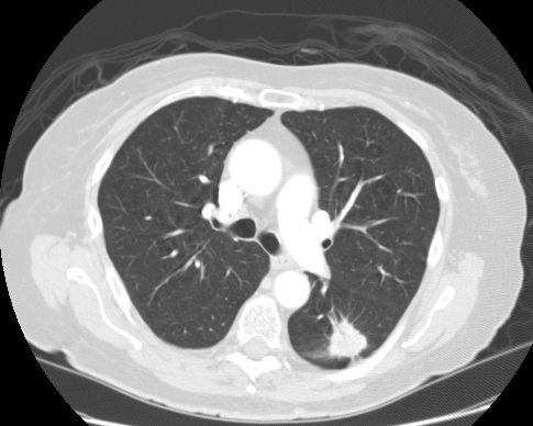 Lung cancer CT image