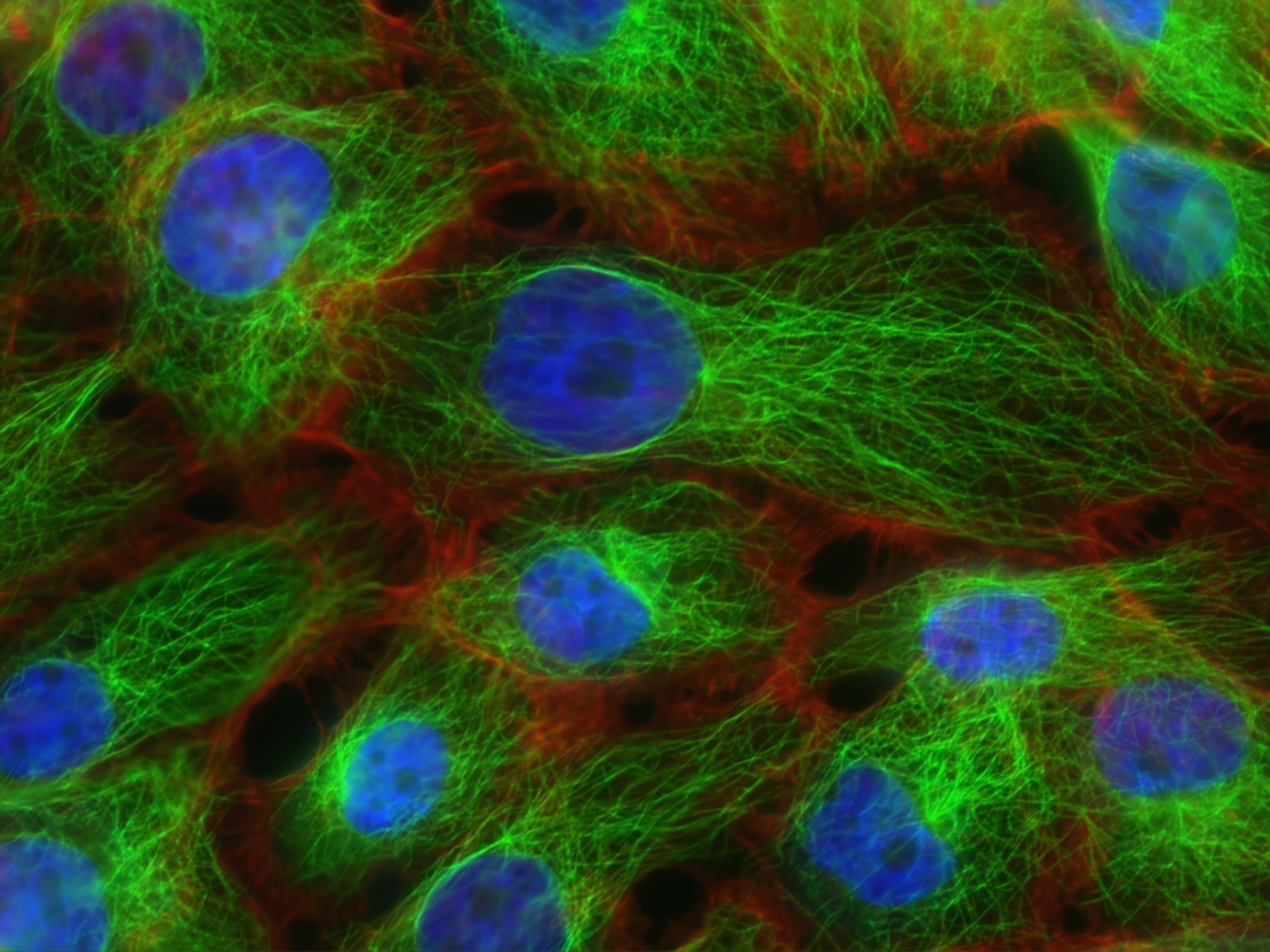 Colorized illustration of breast cancer cells. 
