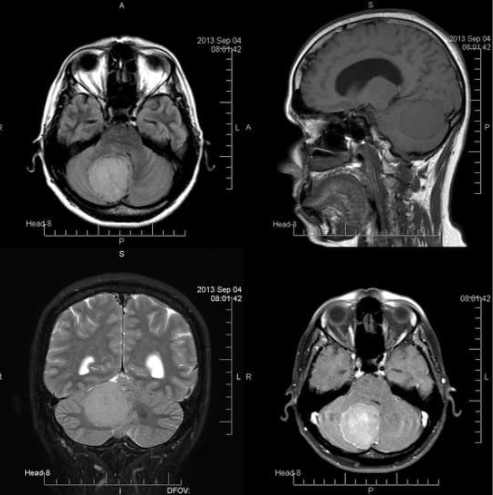 CAT scan image of brain; scan shows four different images of a brain with tumor from different perspectives (side and top).