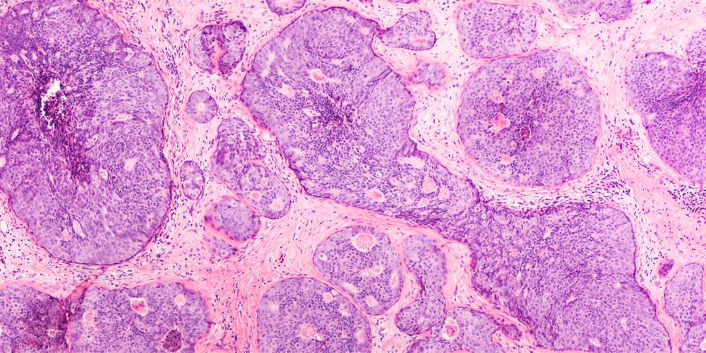 Image shows cells treated with hematoxylin and eosin staining (H&E), a process that helps scientists differentiate between normal and diseased cell structures. Here H&E staining shows several bright pink cells, many of which are in the process of dividing, indicating the presence of cancer cells.