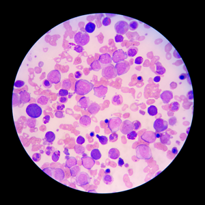 Image shows a blood smear as it appears under a microscope. The cells are stained purple to differentiate between different cell types. 