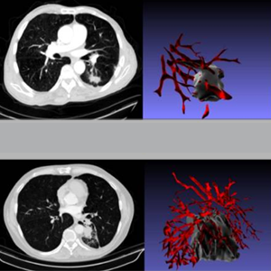 Figure shows CT scans and corresponding 3-D renderings of tumor vasculature for people who responded to therapy vs. those who didn't. Tumor vasculature in non-responders had more twists and turns than those who responded to treatment.