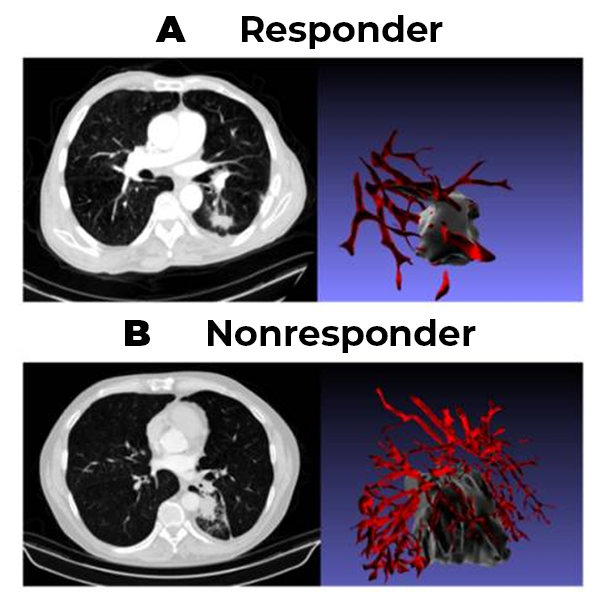 Figure shows CT scans and corresponding 3-D renderings of tumor vasculature for people who responded to therapy vs. those who didn't. Tumor vasculature in non-responders had more twists and turns than those who responded to treatment.
