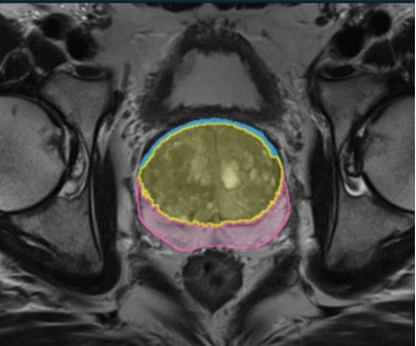 MRI image of the prostate showing segmentation of the core and peripheral zones.