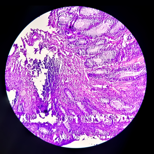Pathology image of H&E stained slide showing colorectal cancer