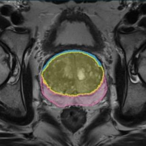 MRI image of the prostate showing segmentation of the core and peripheral zones.