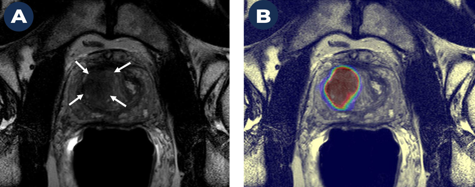 A Magnetic Resonance Image (MRI) on the left (A) shows a suspicious cancer lesion (dark mass marked by arrows). A deep learning-based AI algorithm helps further define this lesion as prostate cancer (B). The lesion in B is displayed as a large red mass, outlined in blue and green. The lesion in B is much larger than the one shown in A, indicating AI helped to better define the extent of the cancer than MRI alone. 