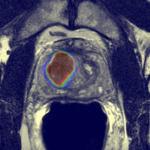 Image shows a cancer lesion. A deep learning-based AI algorithm helps further define this lesion as prostate cancer. The lesion is displayed as a large red mass, outlined in blue and green. 