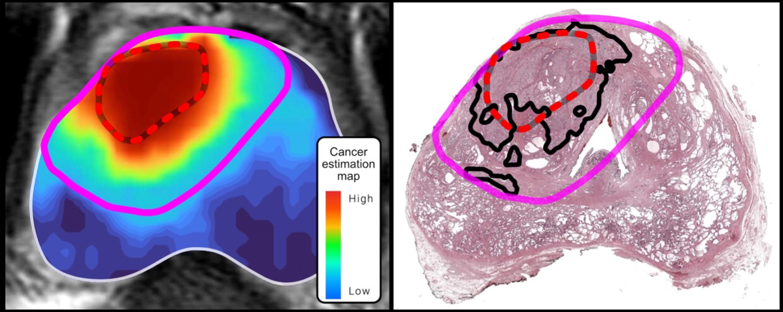 AI-model maps tumor margins, designated by a large oblong circle (shown in pink) that extends well beyond the much smaller margins identified using a conventional MRI approach (shown in red). The region outside the pink circle is blue. Scale on right, which reads “Cancer Estimation Map High Low,” shows the likelihood of cancer, with red being the highest risk and blue being the lowest risk. An image on the right shows histopathological finding. It shows the full extent of the tumor enclosed by black lines. 