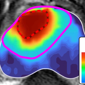 NCI-funded researchers used artificial intelligence to develop an accurate cancer estimation map for defining tumor margins. They found their model outperformed conventional estimates of tumor margins using imaging alone. 