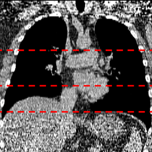 Image shows a non-contrast low-dose chest CT scan. Three red dashed lines run across the chest scan and show the sections selected for body composition assessment. 