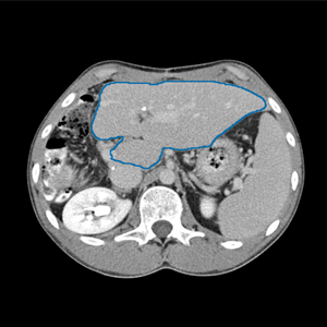 Automatic segmentation of the liver from CT scan of patient TCGA-DD-A1EH