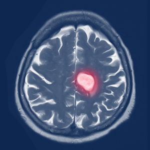 brain cancer imaging