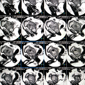 MRI image of an enlarged prostate.