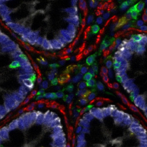 Multimodal image of cancer tumor cells shows how the Orion tool is able to combine two types of images—hematoxylin and eosin and immunofluorescence—in a single slide. 