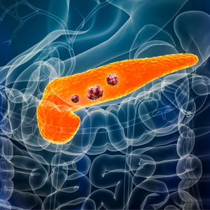 3D rendering illustation of the inside of a male body highlighting the pancreas and tumors. 