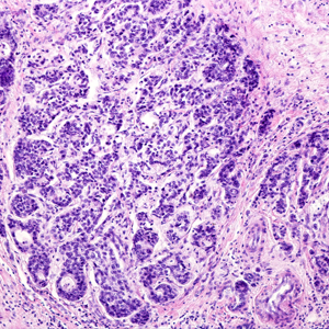 Image of a biopsy showing prostate cancer. Cancerous cells appear as solid sheets of purple, with irregular patterns and arrangements.