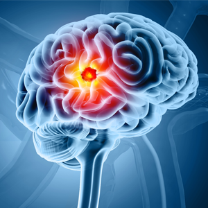 a stylized image of a brain tumor lit up in red, within a brain