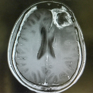 Magnetic resonance image of glioblastoma, shown as a large mass on the upper right-hand side of the brain.