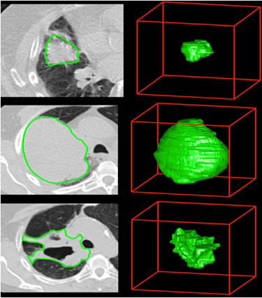 LUNG TUMOR DETECTION AND SEGMENTATION FROM CT SCANS USING DILATED CONVOLUTIONAL NEURAL NETWORKS